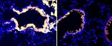 科学家们找到了一种逆转癌症肿瘤免疫抑制的新方法