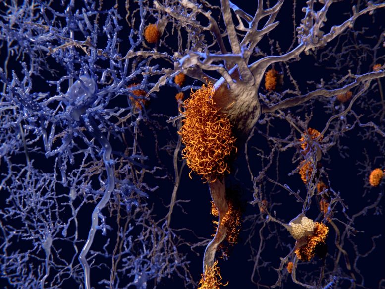 阿尔茨海默病脑神经细胞