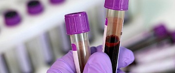 简单的血液测试可以准确地揭示潜在的神经疾病如痴呆症、ALS等